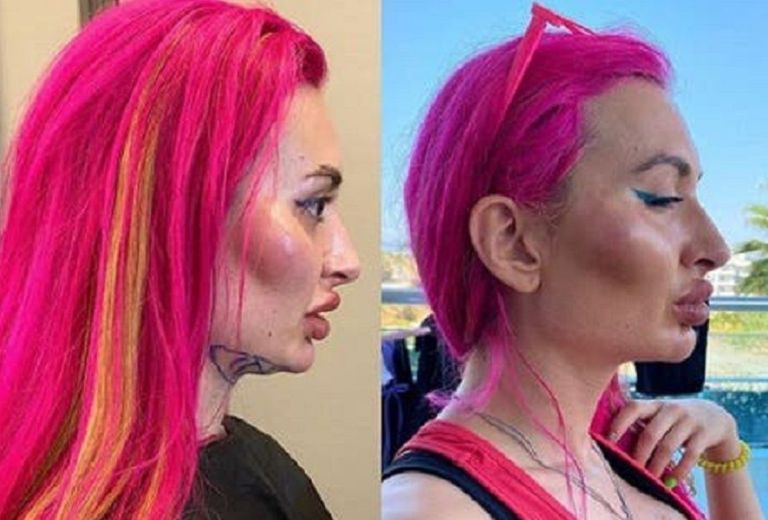 El sorprendente antes y después de la mujer con los pómulos más grandes